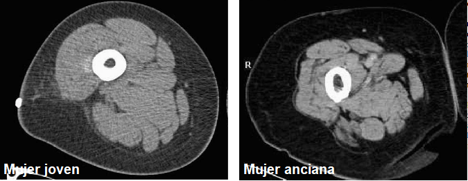 Ejercicio terapéutico en el adulto mayor